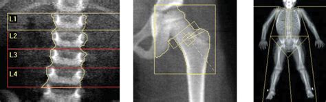 kemik dansitometresi nasıl ölçülür